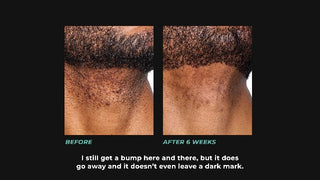 How to Treat & Prevent Ingrown Hairs & Razor Bumps for Men