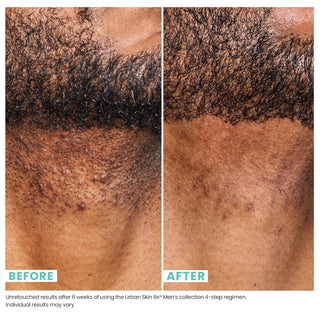 Daily Razor Bump + Dark Spot Treatment, Urban Skin Rx® Men, 50ml