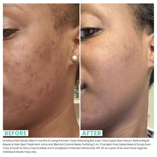 Urban Skin Rx ACNE AND BLEMISH SULFUR MASK 73ML