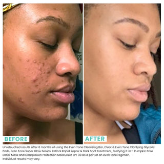 Urban Skin Rx Combination Skin Cleansing 3-in-1 Treatment Bar, 56g