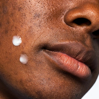 Urban Skin Rx Clear Complexion Acne Serum + Spot Treatment 30ml