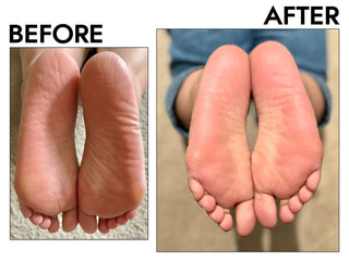 Say Goodbye to Cracked Heels: Causes & Remedies for Dry Feet